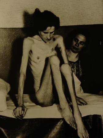 Very thin woman, naked on hospital bed
